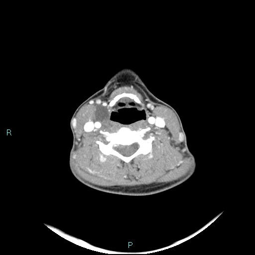 Cervical thymic cyst (Radiopaedia 88632-105335 B 56).jpg
