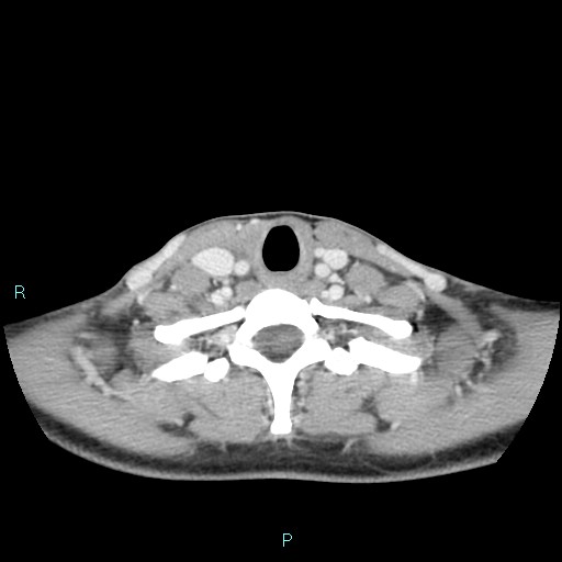 Cervical thymic cyst (Radiopaedia 88632-105335 C 39).jpg