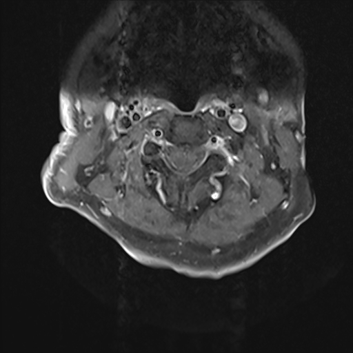 File:Cervical tumor-like myelopathy due to Type V dAVF (Radiopaedia 82461-96604 Axial T1 C+ fat sat 11).jpg