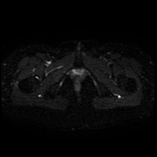 File:Cesarian section scar endometriosis (Radiopaedia 66520-75799 Axial DWI 25).jpg