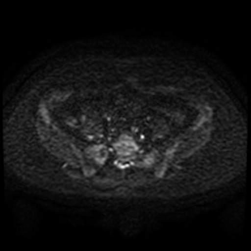 Cesarian section scar endometriosis (Radiopaedia 66520-75799 Axial DWI 53).jpg