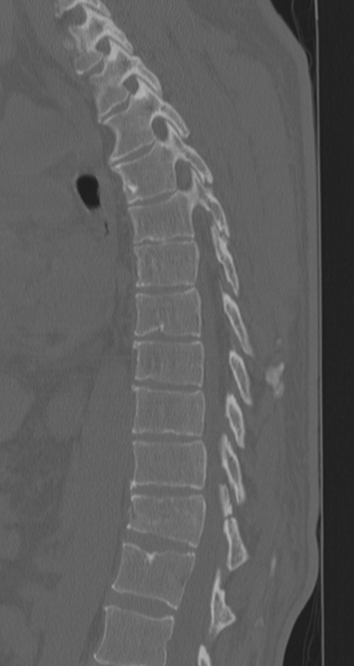 Chance fracture (Radiopaedia 33854-35020 Sagittal bone window 39).png