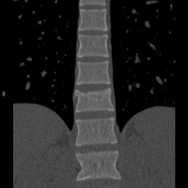 File:Chance fracture (Radiopaedia 36521-38081 Coronal bone window 17).jpg