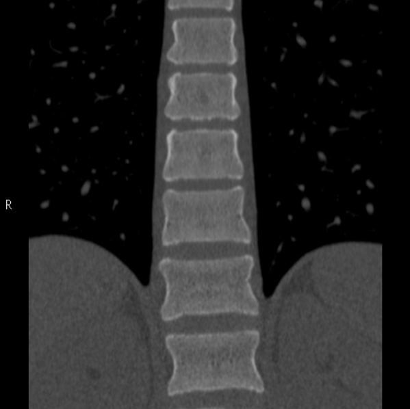 Chance fracture (Radiopaedia 36521-38081 Coronal bone window 26).jpg