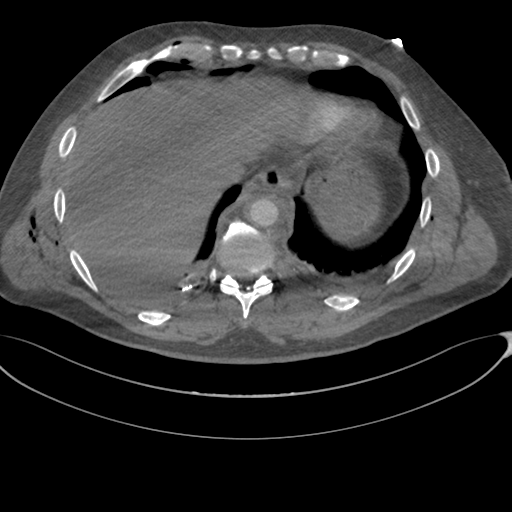 File:Chest multitrauma - aortic injury (Radiopaedia 34708-36147 A 242).png