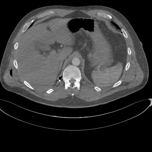 File:Chest multitrauma - aortic injury (Radiopaedia 34708-36147 A 282).png