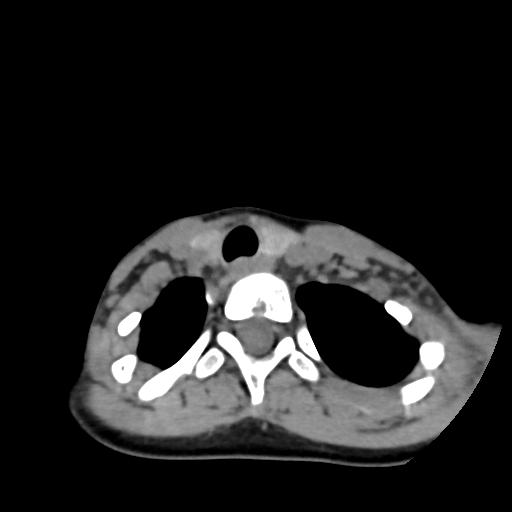 Chiari I with syrinx and skull base anomalies (Radiopaedia 89444-106412 Axial non-contrast 126).jpg