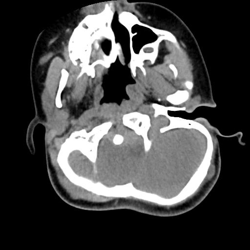 Chiari I with syrinx and skull base anomalies (Radiopaedia 89444-106412 Axial non-contrast 38).jpg