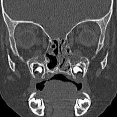 Choanal atresia (Radiopaedia 88525-105975 Coronal bone window 44).jpg