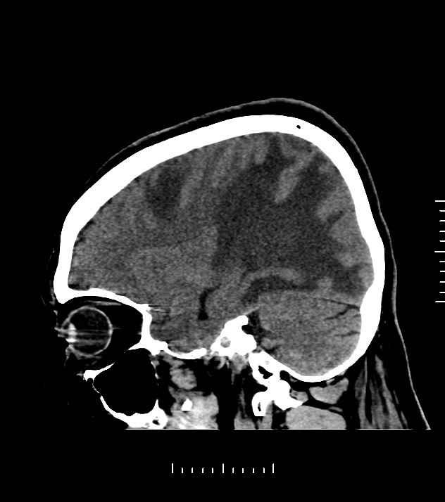 Cholangiocarcinoma with cerebral metastases (Radiopaedia 83519-98628 C 16).jpg