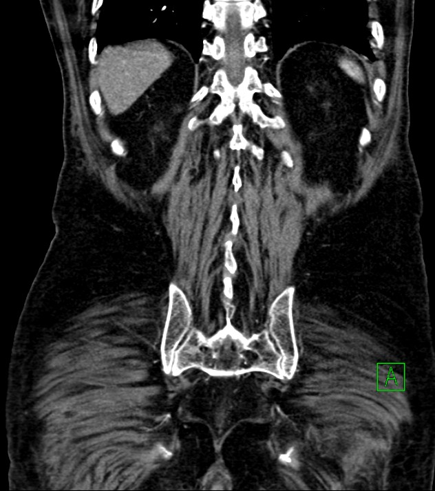 Cholangiocarcinoma with cerebral metastases (Radiopaedia 83519-98629 E 72).jpg