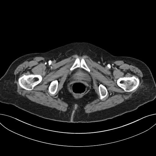 Cholecystoduodenal fistula due to calculous cholecystitis with gallstone migration (Radiopaedia 86875-103077 A 76).jpg
