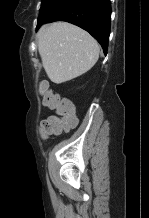 Cholecystoduodenal fistula due to calculous cholecystitis with gallstone migration (Radiopaedia 86875-103077 F 49).jpg