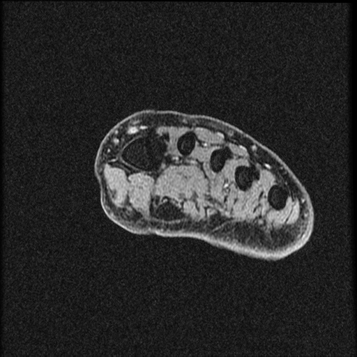 File:Chondroblastoma - midfoot (Radiopaedia 64831-73765 F 25).jpg