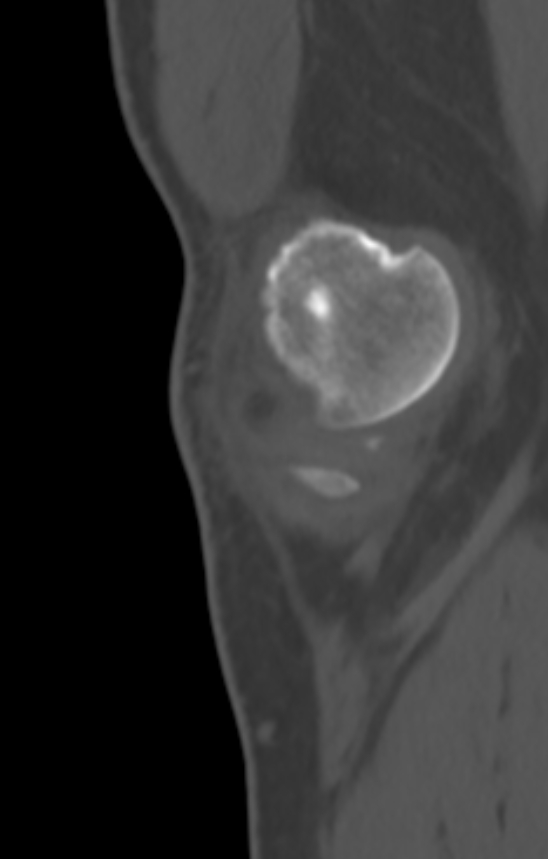 Chondrocalcinosis (Radiopaedia 82862-97173 Sagittal bone window 4).jpg