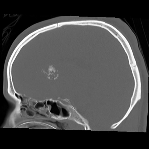 File:Chondrosarcoma - sphenoid wing (Radiopaedia 58259-67828 Sagittal bone window 17).jpg