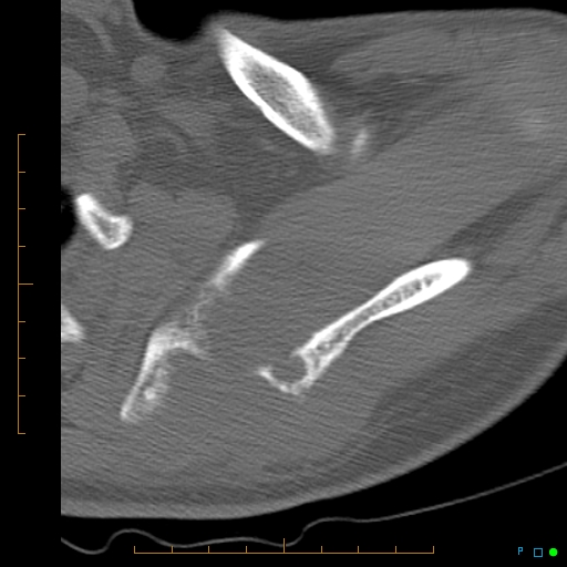 File:Chondrosarcoma of the scapula (Radiopaedia 30696-31399 Axial non-contrast 12).jpg
