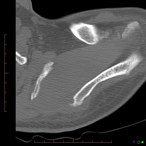 File:Chondrosarcoma of the scapula (Radiopaedia 30696-31399 Axial non-contrast 15).jpg