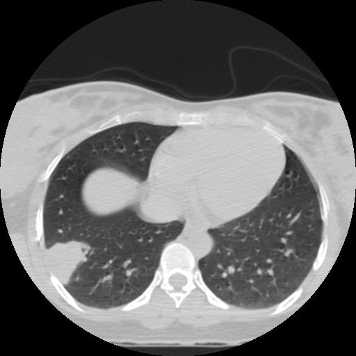 File:Choriocarcinoma of ovary with cerebral and pulmonary metastases (Radiopaedia 25983-26119 Axial lung window 15).jpg