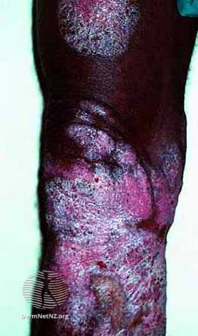 File:Chromoblastomycosis (DermNet NZ fungal-chrobla).jpg