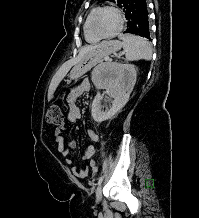 Chromophobe renal cell carcinoma (Radiopaedia 84239-99519 G 39).jpg