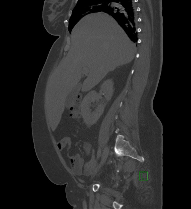 Chromophobe renal cell carcinoma (Radiopaedia 84239-99519 Sagittal bone window 71).jpg