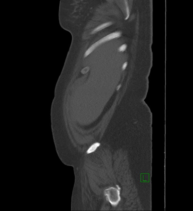 Chromophobe renal cell carcinoma (Radiopaedia 84239-99519 Sagittal bone window 98).jpg