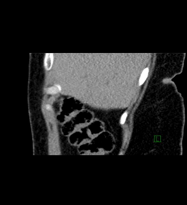 Chromophobe renal cell carcinoma (Radiopaedia 84290-99582 D 84).jpg