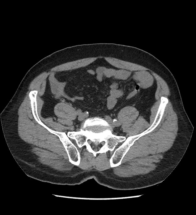 Chromophobe renal cell carcinoma (Radiopaedia 86879-103083 Axial non-contrast 92).jpg