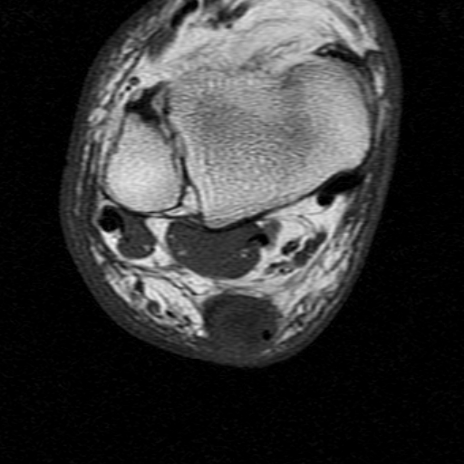File:Chronic Achilles tendon rupture (Radiopaedia 15262-15100 Axial T1 11).jpg