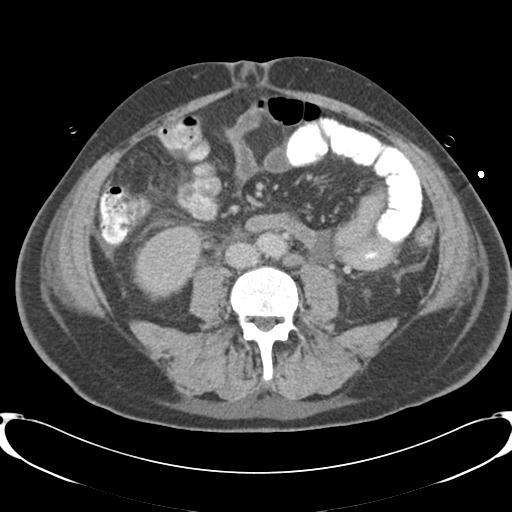 Chronic diverticulitis complicated by hepatic abscess and portal vein thrombosis (Radiopaedia 30301-30938 A 56).jpg