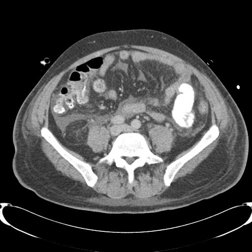 Chronic diverticulitis complicated by hepatic abscess and portal vein thrombosis (Radiopaedia 30301-30938 A 62).jpg