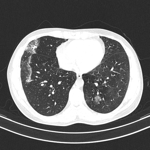 Chronic eosinophilic pneumonia (Radiopaedia 39331-41587 Axial lung window 38).png