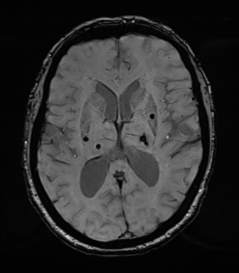 Chronic hypertensive encephalopathy (Radiopaedia 39993-42482 Axial SWI 48).png