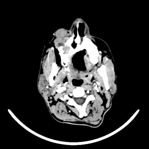 Chronic invasive fungal sinusitis with intraorbital and intracranial extension (Radiopaedia 56387-63046 B 5).jpg