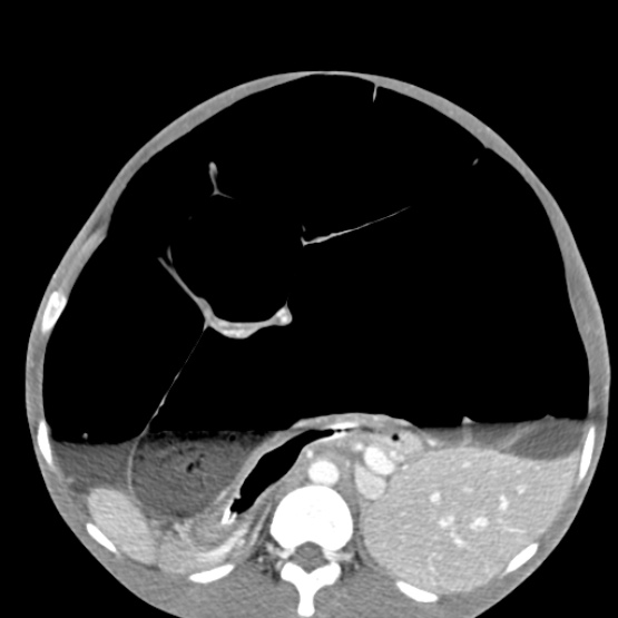 Chronic large bowel pseudo-obstruction (Radiopaedia 43181-46492 A 72).jpg