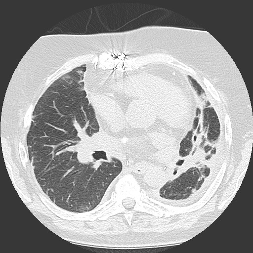 Chronic lung allograft dysfunction - restrictive form (Radiopaedia 60595-68316 Axial lung window 35).jpg