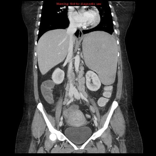 File:Chronic myeloid leukemia with splenic infarction (Radiopaedia 9178-9874 E 38).jpg