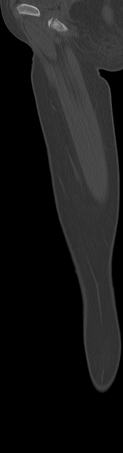 Chronic ostemyelitis of the femur with long sinus tract (Radiopaedia 74947-85982 Sagittal bone window 81).jpg
