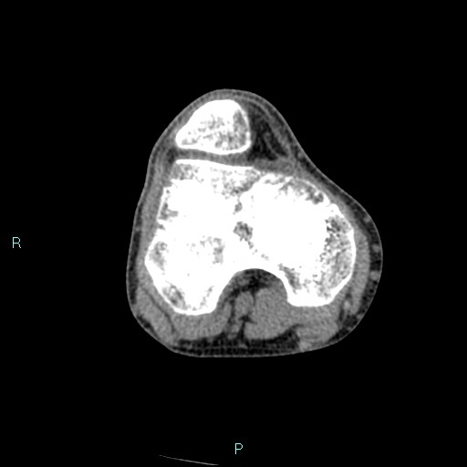 Chronic osteomyelitis (with Brodie abscess) (Radiopaedia 76405-88111 A 138).jpg
