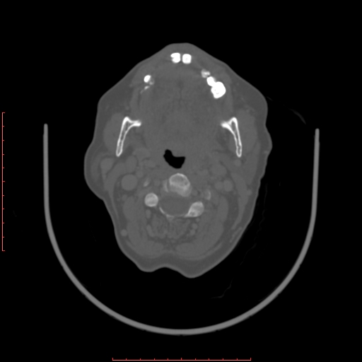 Chronic osteomyelitis - maxilla (Radiopaedia 23783-23927 Axial bone window 50).jpg