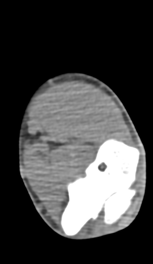 Chronic osteomyelitis of the distal humerus (Radiopaedia 78351-90971 Axial non-contrast 93).jpg