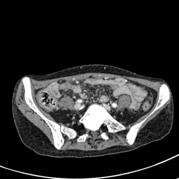 Chronic pancreatitis (Radiopaedia 55405-61846 A 75).jpg
