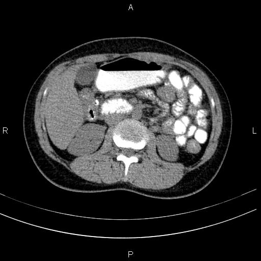 Chronic pancreatitis (Radiopaedia 64576-73450 Axial non-contrast 68).jpg