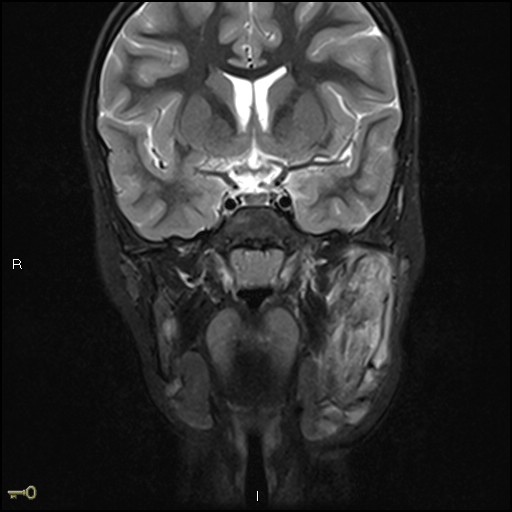 File:Chronic reactive multifocal osteomyelitis (CRMO) - mandible (Radiopaedia 56405-63069 Coronal STIR 18).jpg