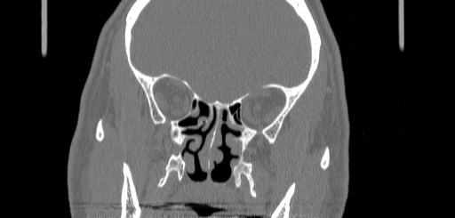 File:Chronic sphenoidal sinusitis (Radiopaedia 62030-70122 Coronal bone window 85).jpg