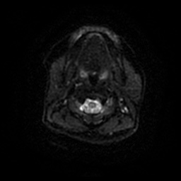 Chronic submandibular sialadenitis (Radiopaedia 61852-69885 Axial DWI 42).jpg