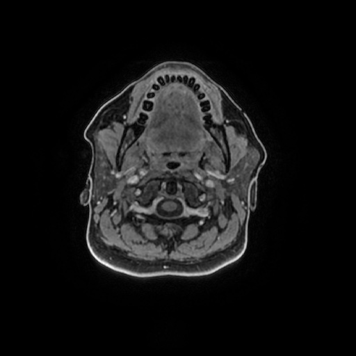 Chronic submandibular sialadenitis (Radiopaedia 61852-69885 Axial T1 C+ fat sat 81).jpg