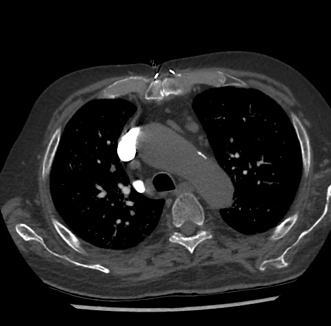 Chronic thromboembolic pulmonary disease (Radiopaedia 90694-108119 Axial C+ CTPA 31).jpg