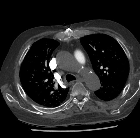 File:Chronic thromboembolic pulmonary disease (Radiopaedia 90694-108119 Axial C+ CTPA 34).jpg
